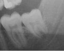 SoftTissueImpactions